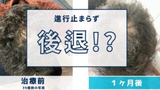 AGA治療1ヶ月目の経過|抜け毛が増えて不安だった私のリアルな記録
