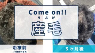 AGA治療3ヶ月目の変化|不安から希望へ…産毛に気づいた私の実感記録