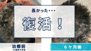 AGA治療6ヶ月目の経過|見た目に明らかな変化!心も髪も変わった半年間