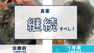 AGA治療から1年後の現実|安心と後悔…やめたらどうなったのか?